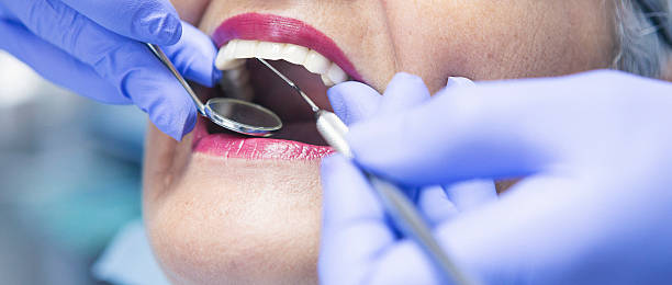 Best Knocked-Out Tooth (Avulsed Tooth) Treatment in Fillmore, UT